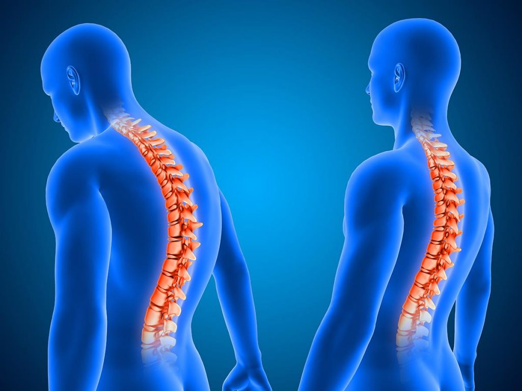 کیفوز شوئرمن