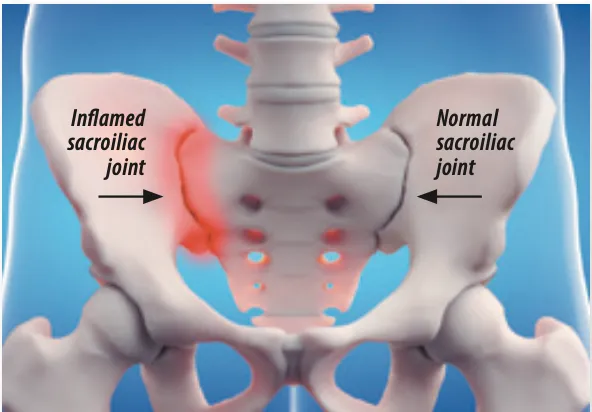 التهاب مفصل ساکروایلیاک